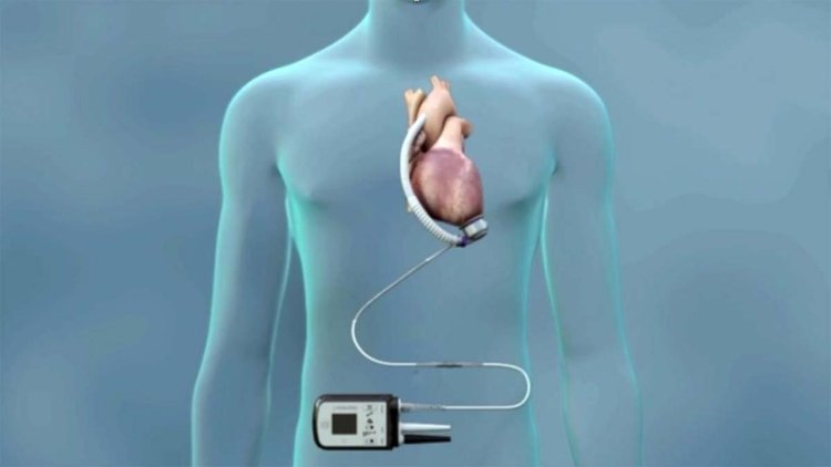 Ventricular Assist Device Market Report | Growth, Size by 2025-2033