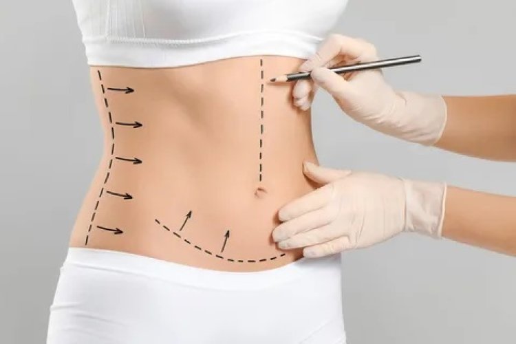 Revision Liposuction in Dubai: Addressing Unsatisfactory Results and Refining Previous Procedures.