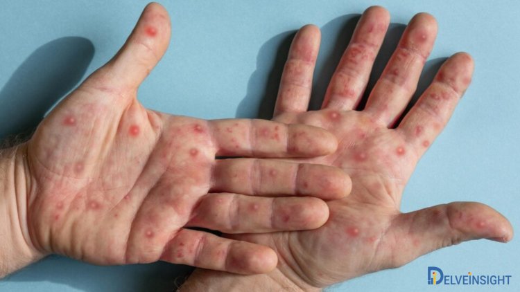 Pemphigus Vulgaris Drug Market Outlook 2034: Approvals, Clinical Status, Epidemiology, NDA Status, Revenue, Mechanism of Action, Leading Therapies, and Key Players - DelveInsight Report