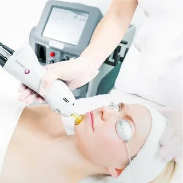 Treating Acne Scars with Lasers in Dubai: A Comprehensive Guide