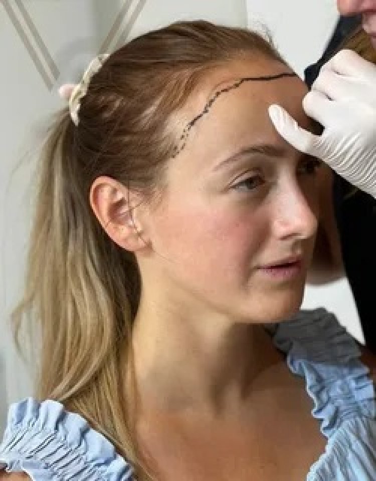 Female Hair Transplant in Dubai: Addressing Unique Hair Loss Patterns and Considerations