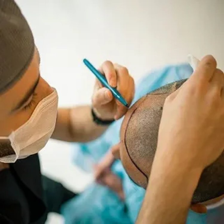 Hair Transplant Side Effects: What You Should Know Before Booking in Islamabad