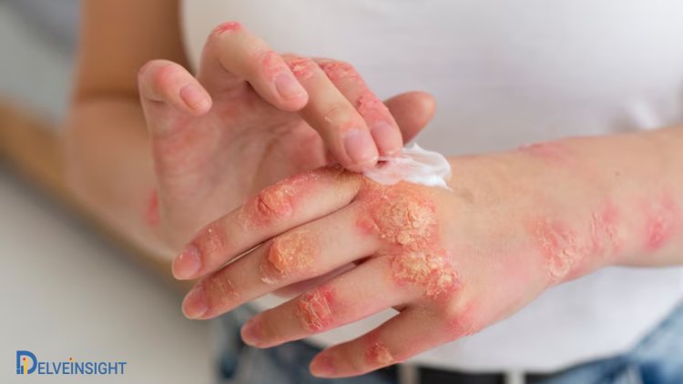 Chronic Plaque Psoriasis Market to Show Significant Growth Trend from 2024 to 2034, DelveInsight Report | Zai Lab, UCB Biopharma SRL, Taizhou Mabtech Pharma, Sun Pharma, Janssen R&D, Livzon Pharma