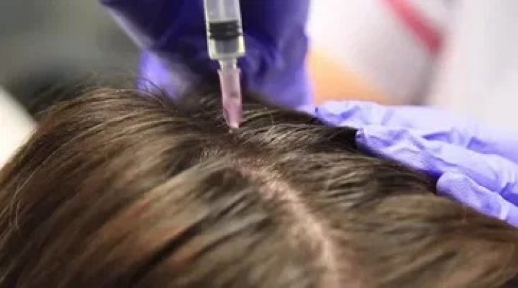 Comparing Hair Fillers to Other Hair Loss Treatments: Minoxidil, Finasteride, and PRP