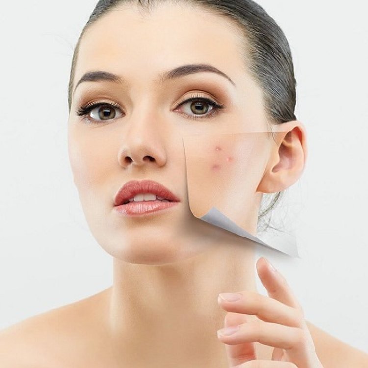 What is the cost range for acne scar removal treatments in Islamabad?