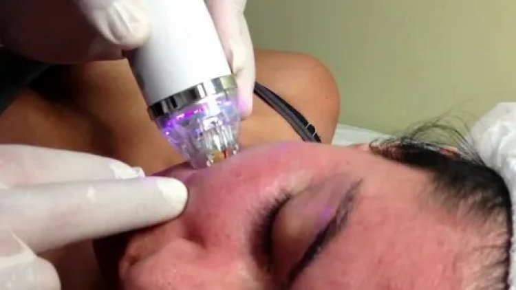 Fractional RF Micro Needling for Specific Skin Issues: Pigmentation, Large Pores, and Wrinkles