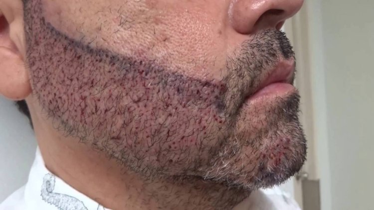 Dynamic Aesthetic Clinic: Tailored Beard Transplant Solutions