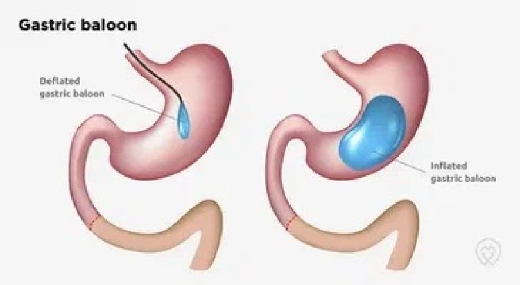 The Role of Dietary Changes and Nutritional Guidance with a Gastric Balloon