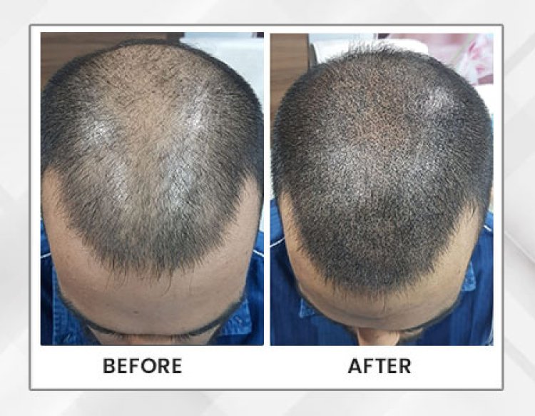 PRP Therapy for Hair Growth: Insights from a Hair Specialist in Guwahati