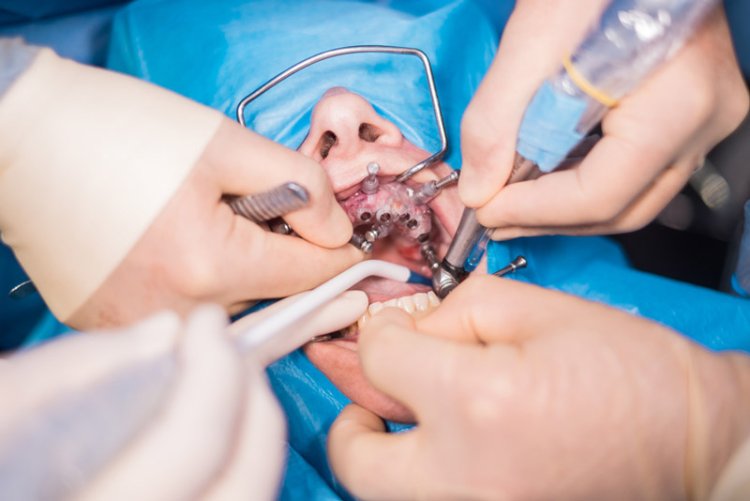 Common Procedures Performed by an Oral and Maxillofacial Surgeon in Dubai