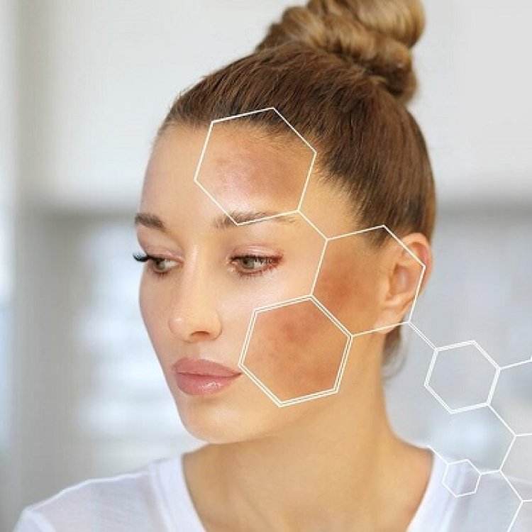 Role of Sun Exposure in Melasma and How to Protect Your Skin in Islamabad