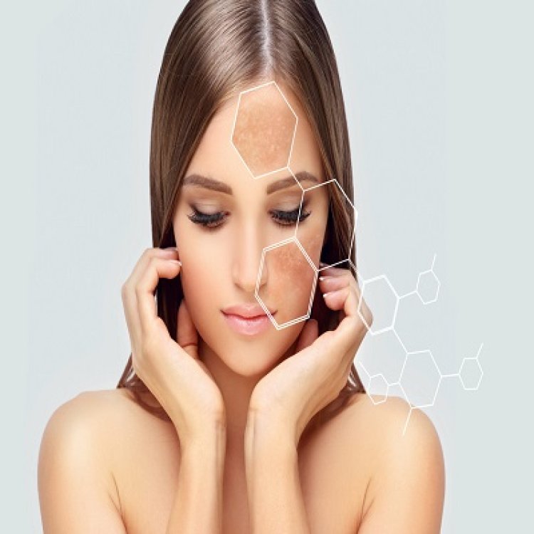 Can Melasma Go Away On Its Own? Facts You Should Know