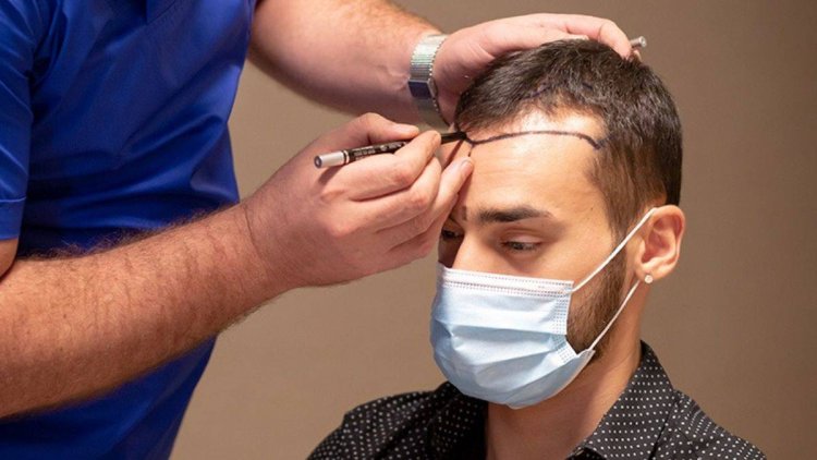 How Long Do Transplanted Hairs Last in Islamabad Climate?