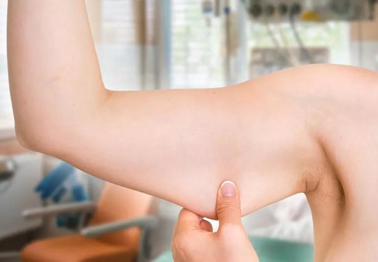Arm Lift Surgery: The Best Treatment for Excess Skin on Arms