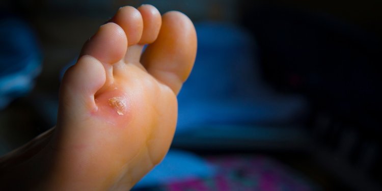 Homeopathic Treatment for Corns and Calluses | Sahil Homoeo Care