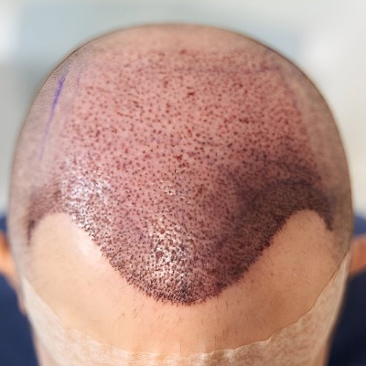 Benefits of Choosing FUT Hair Transplant in Islamabad