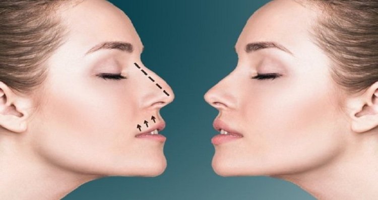 كم تبلغ تكلفة تجميل الأنف في الرياض؟