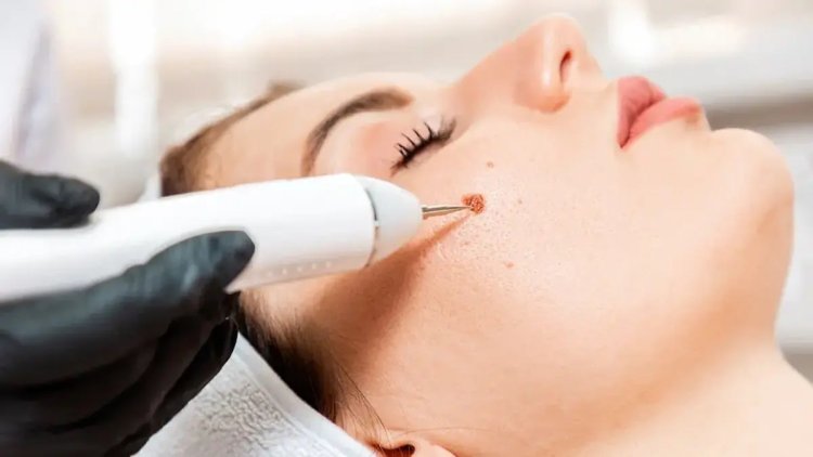 What happens after wart removal?