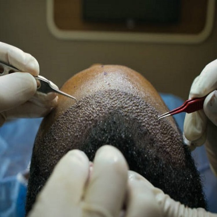 Are Low-Cost Hair Transplants in Islamabad Safe?