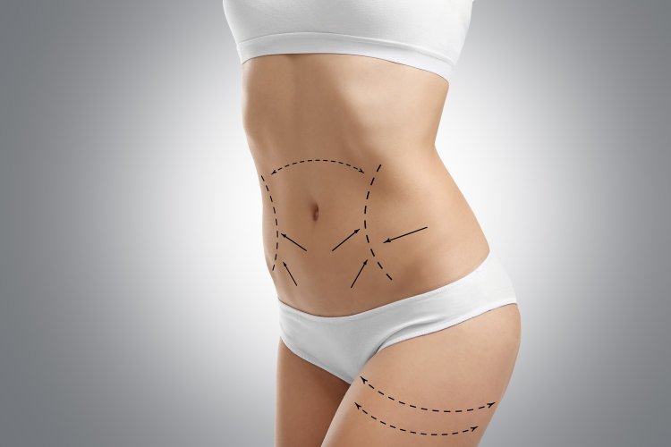 Liposuction Surgery: Expert Advice and Insights