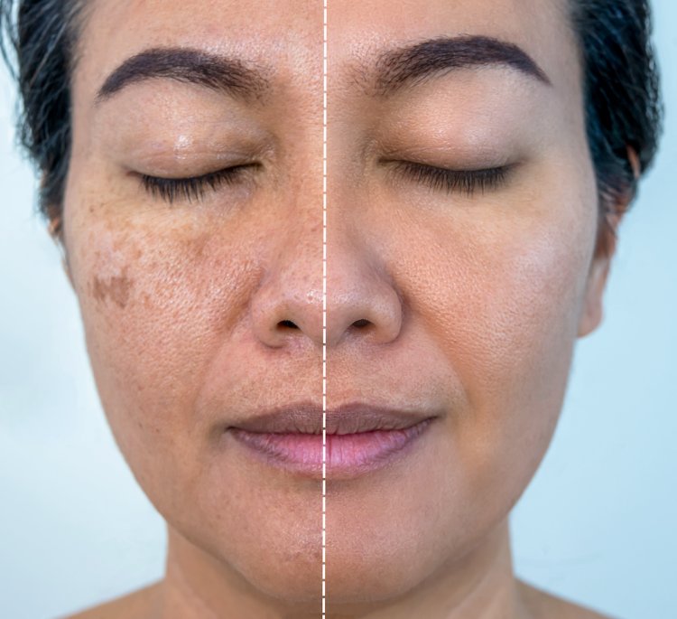 How Intense Pulsed Light (IPL) Helps Treat Melasma