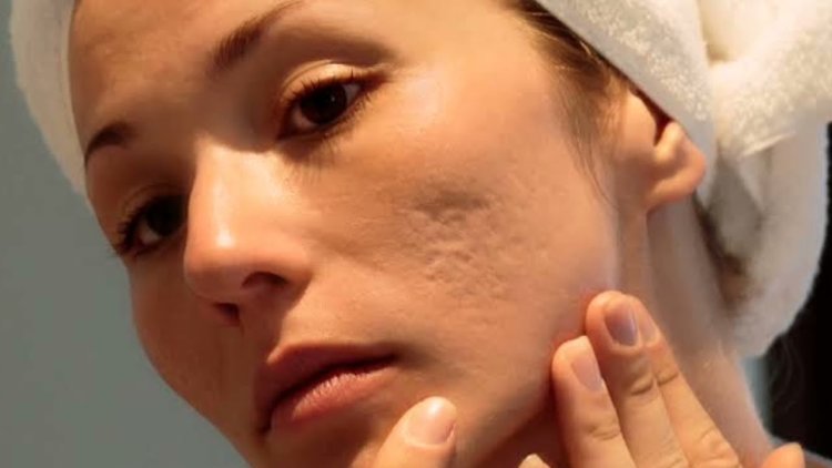 Best Treatment for Boxcar Scars in Islamabad