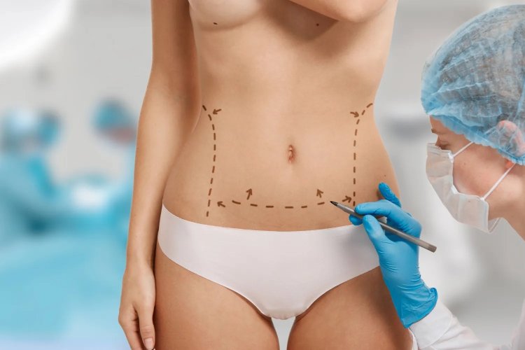 Liposuction Surgery: Myths vs. Reality