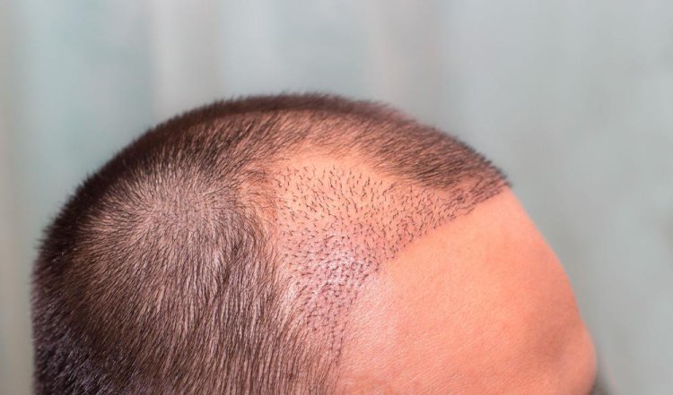 FUE Hair Transplant in India – Why More People Trust Crown “The Hair Transplant Experts”