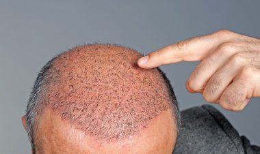 What Is a Hair Graft?