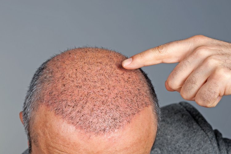 What Is a Hair Graft?